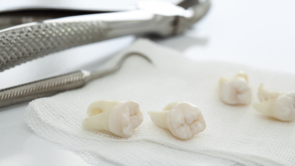 DA LI SVI UMNJACI TREBA DA SE VADE?