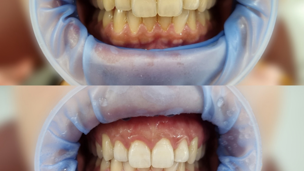 KUĆNO BELJENJE ZUBA