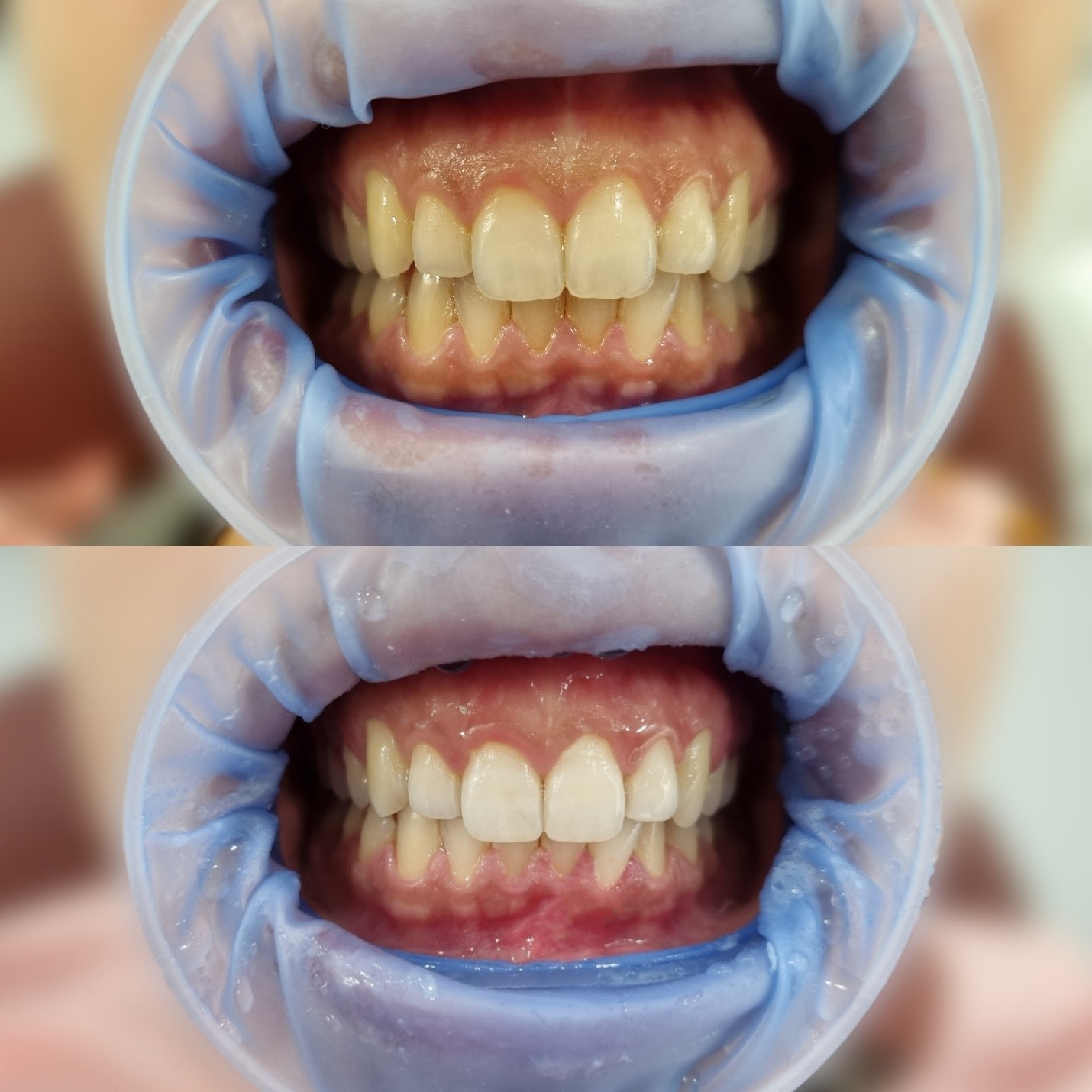 KUĆNO BELJENJE ZUBA