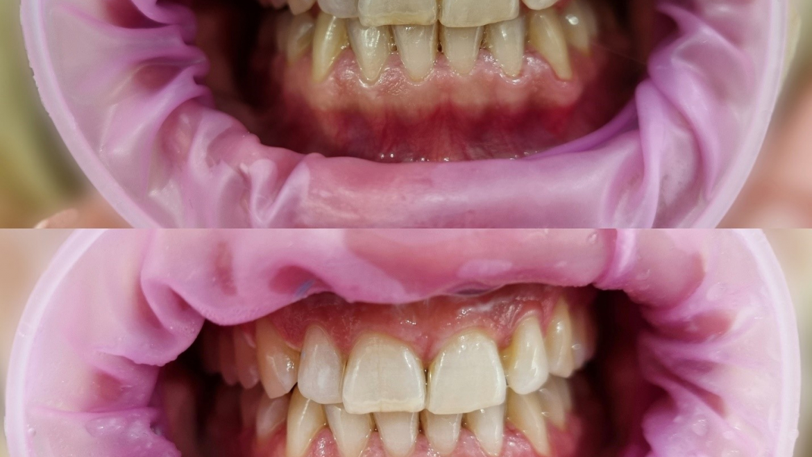 ORDINACIJSKO BELJENJE ZUBA