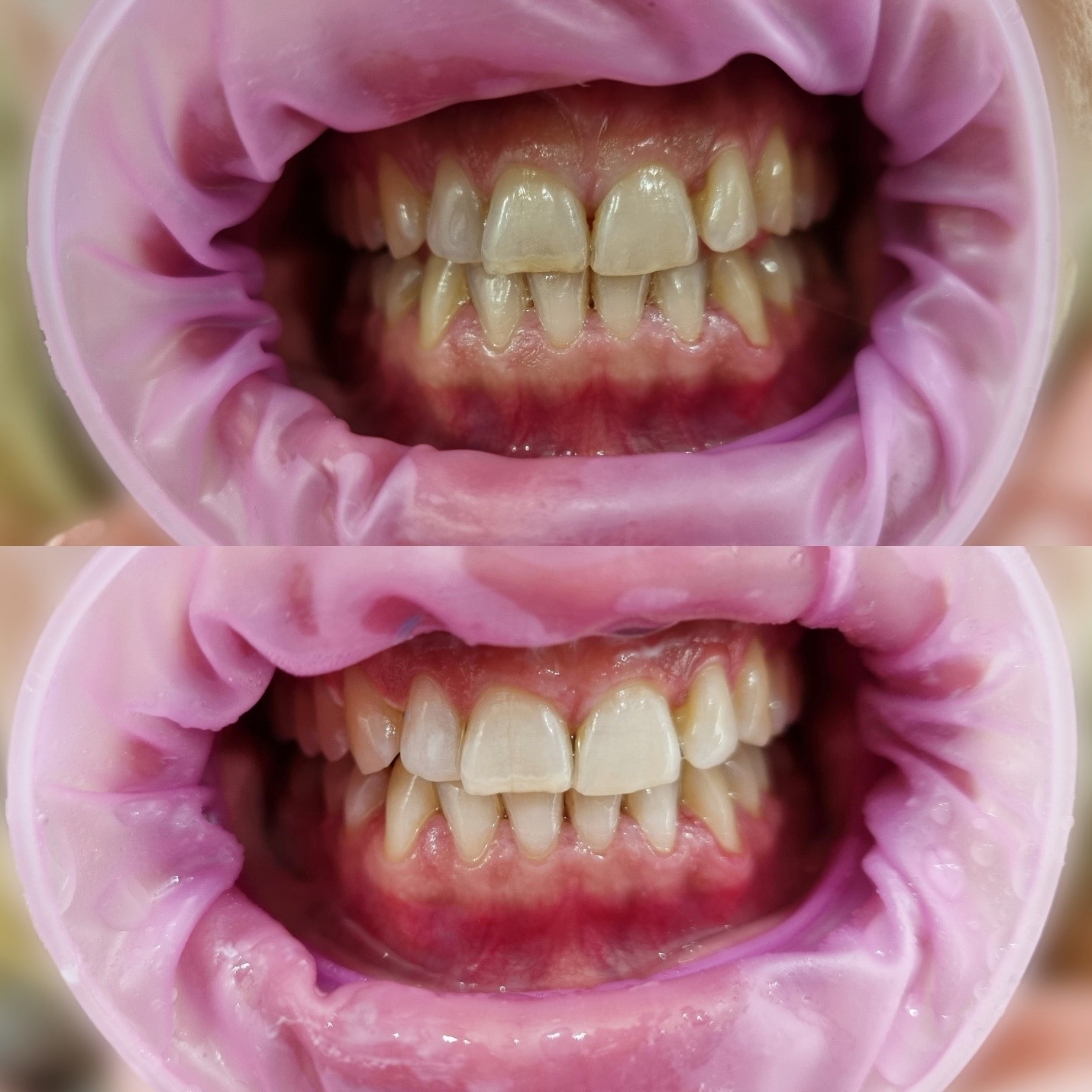 ORDINACIJSKO BELJENJE ZUBA