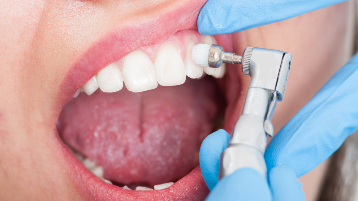 UKLANJANJE MEKIH NASLAGA